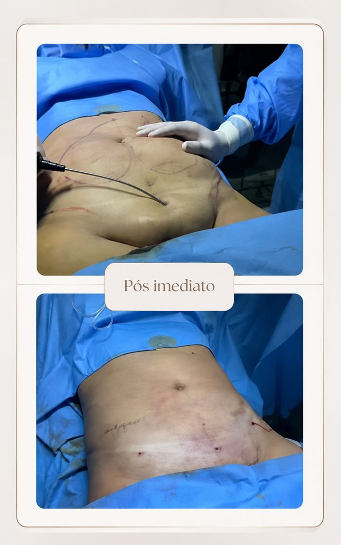 Resultado pós-operatório imediato de lipoaspiração abdominal