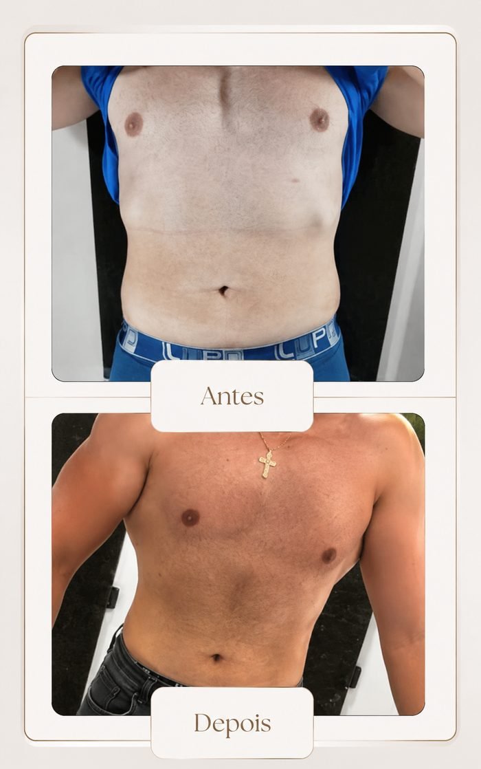 Antes e depois de lipoaspiração de tórax